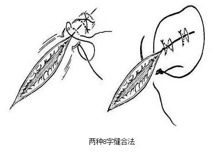 最新伤口缝合技术